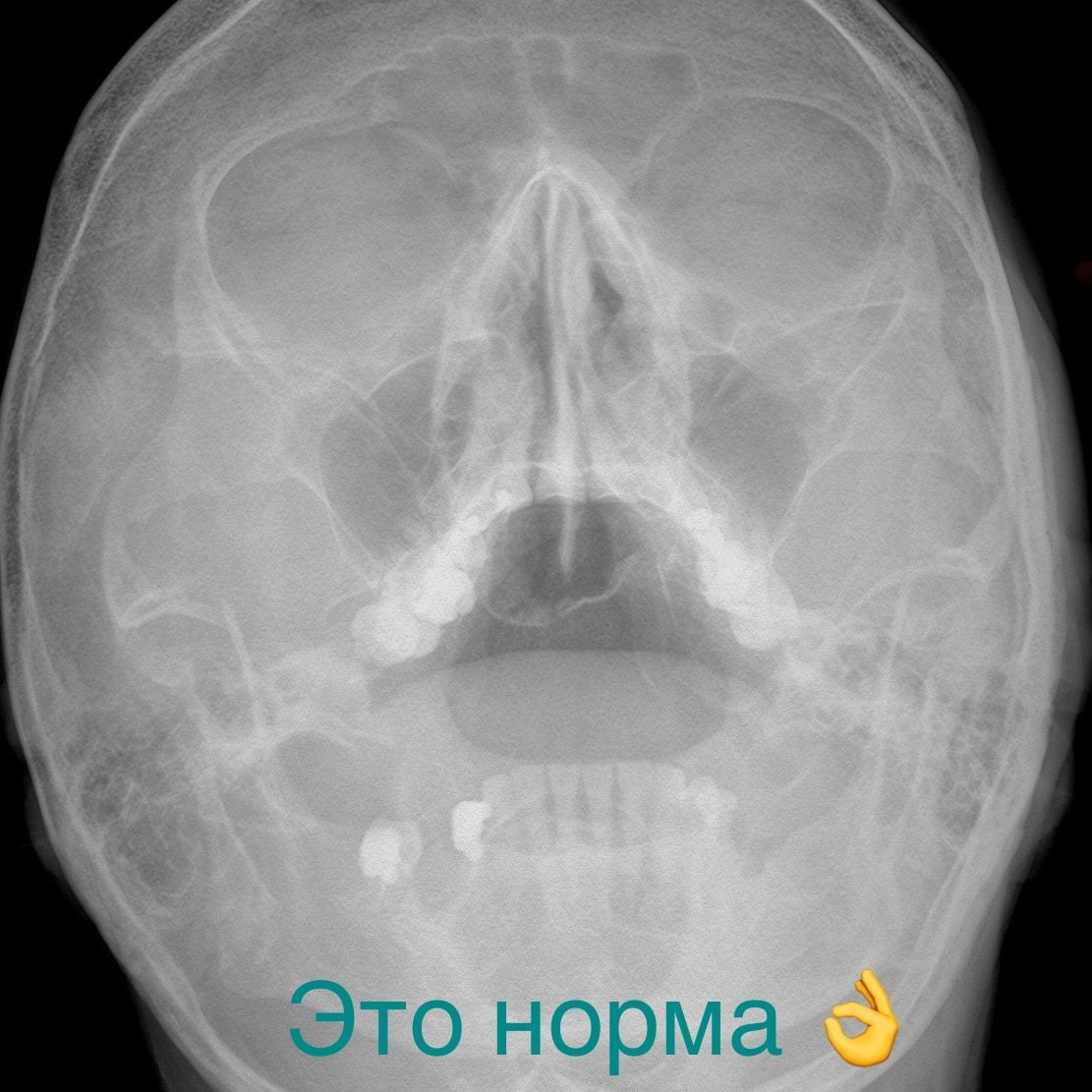 Разбираемся с пазухами на рентгене. Первые шаги. РЕНТГЕН КТ МРТ в Санкт-Петербурге Александра Лоншакова