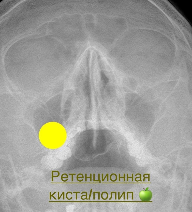 Разбираемся с пазухами на рентгене. Первые шаги. РЕНТГЕН КТ МРТ в Санкт-Петербурге Александра Лоншакова