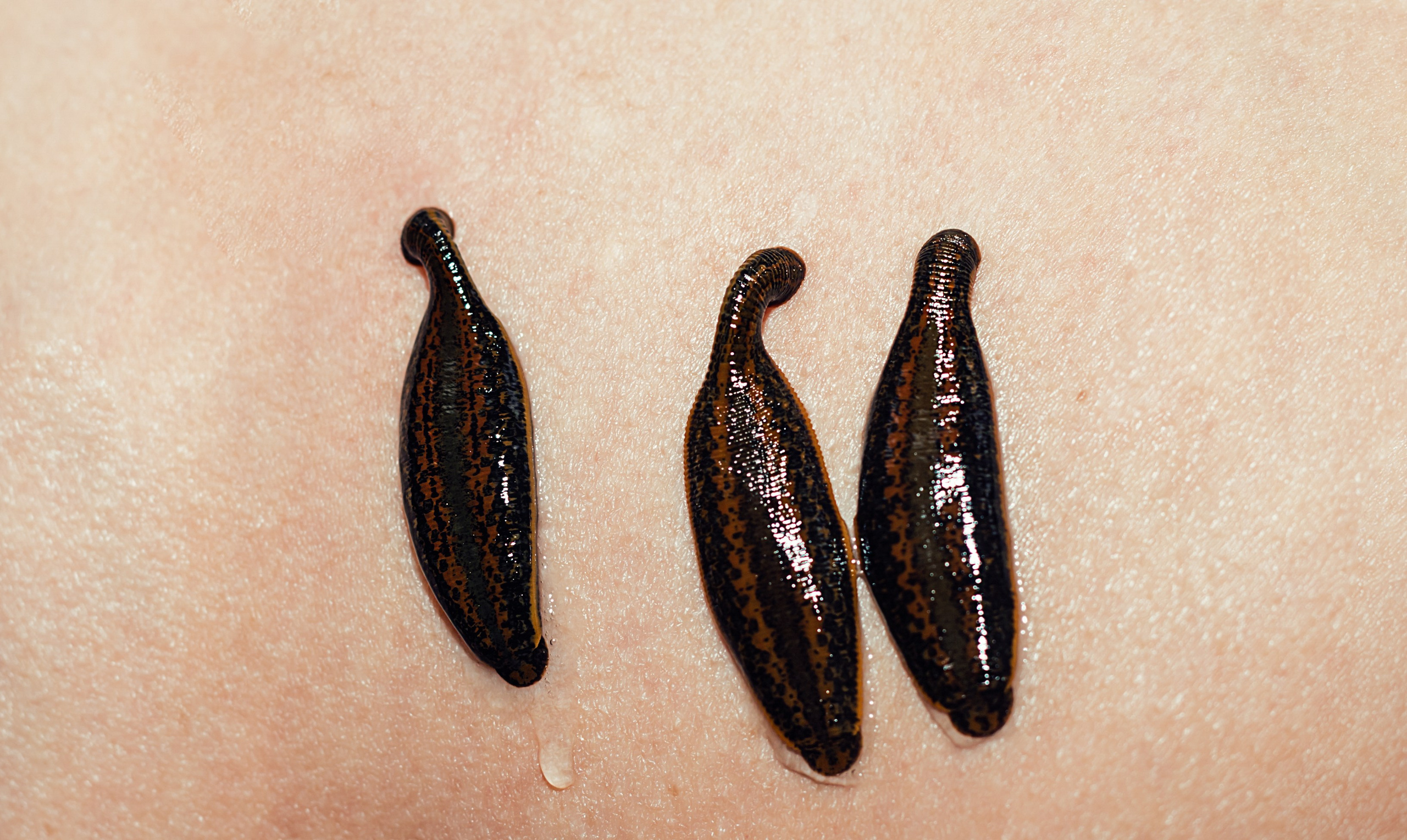 ГИРУДОТЕРАПИЯ. Https://esmassage.ru