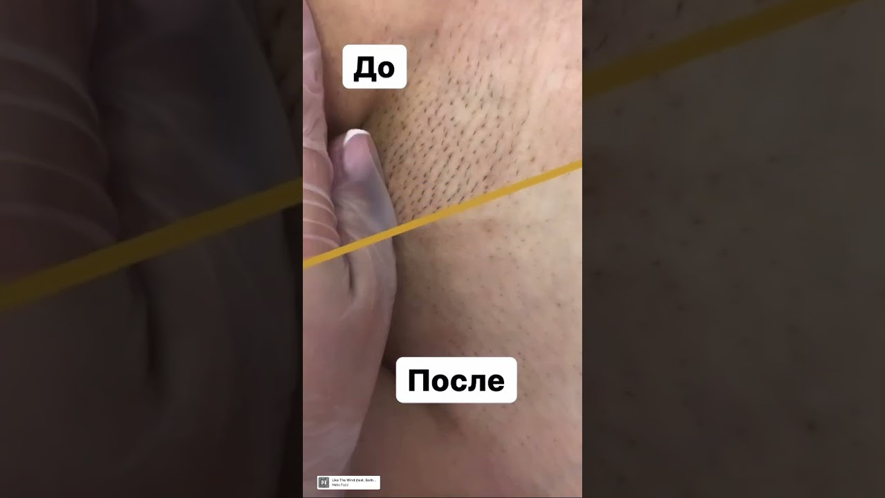 Видео. Лазерная эпиляция в г. Кемерово, г. Новокузнецке и г. Киселевске