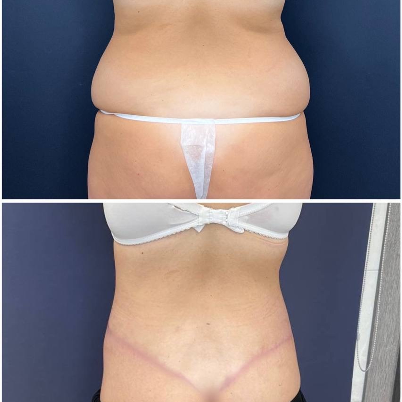 Всех приветствую! Результат нижнего бодилифтинга через 2 месяца после операции.