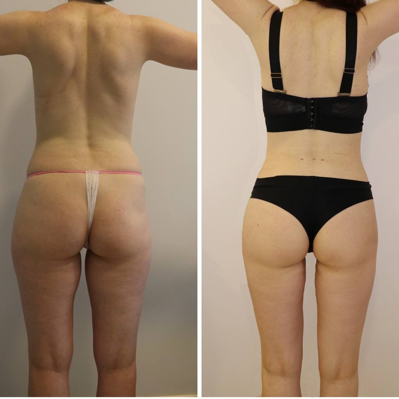 результат липоскульптурирования и&nbsp;липомоделирования.