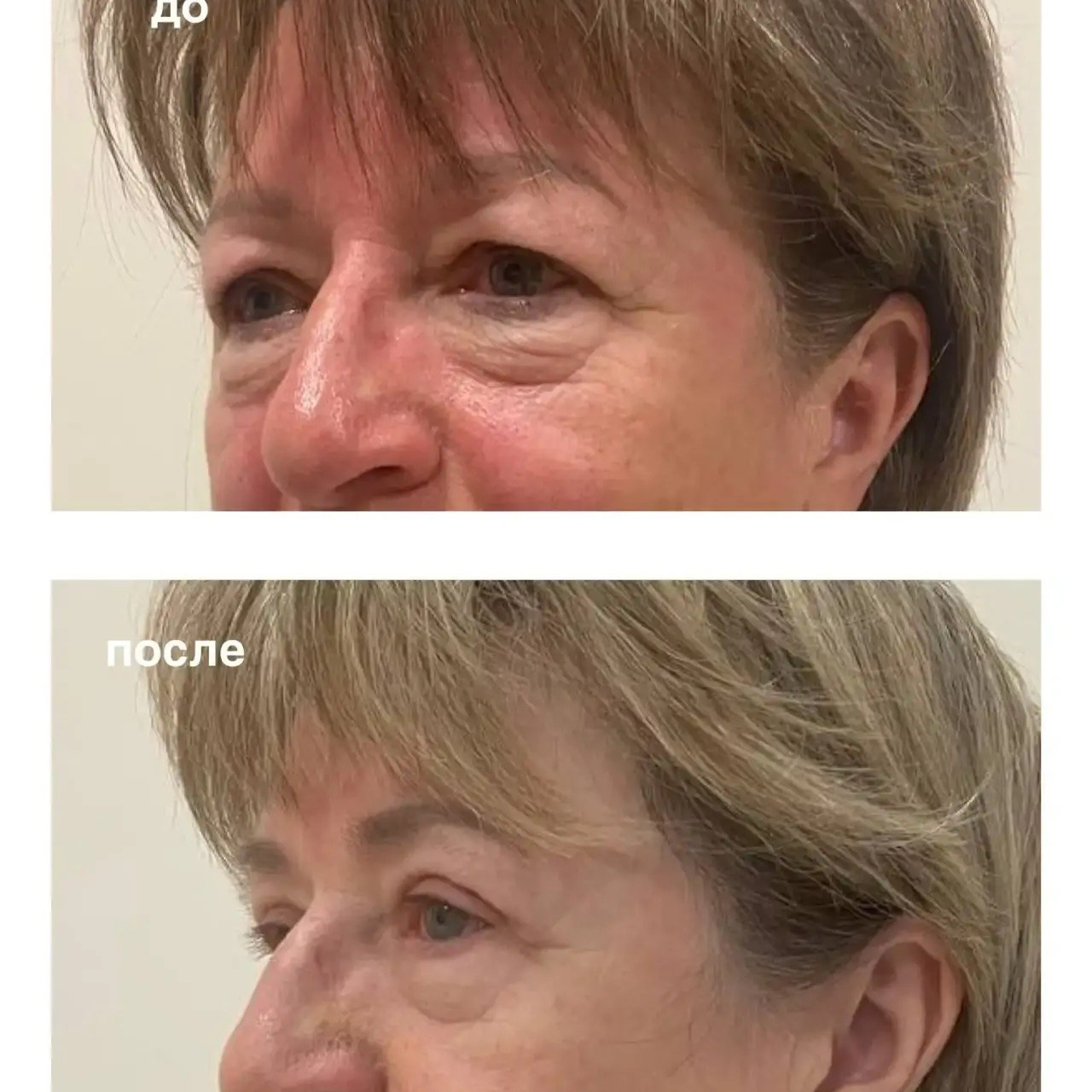 Результат круговой блефаропластики через месяц после операции 💥