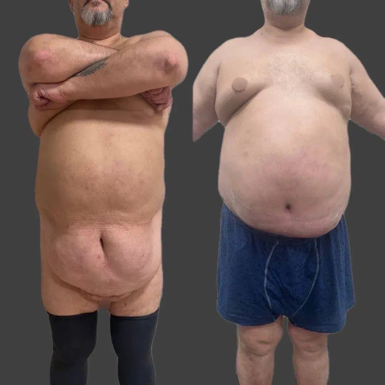 Выполнена абдоминопластика с&nbsp;переносом пупка, удален фартук в&nbsp;объеме 8 кг