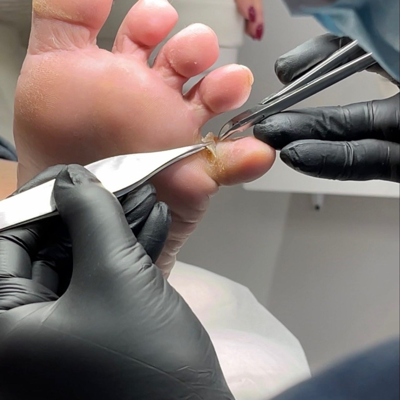 Комплексная подологическая обработка ногтей и стопы 3 степень (ногтевая пластина с признаками грибковой инфекции, онихогрифоз, трещины, гиперкератоз) - 5 000 ₽- 7 500 ₽