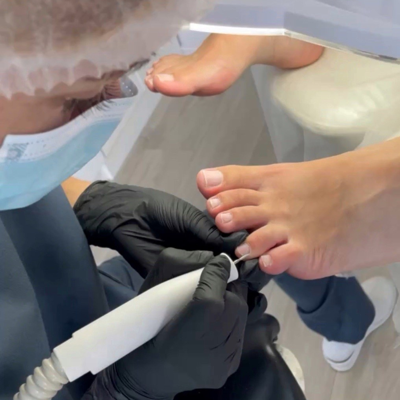 Комплексная подологическая обработка ногтей и стопы 1 степень (незначительная сухость стопы, без деформации ногтевой пластины) - 3 000 ₽