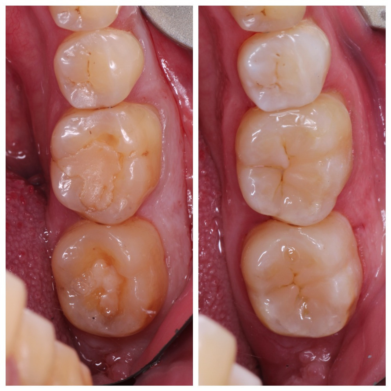 Стоматология в Твери - Линия Улыбки Лечение кариеса. Стоматология в Твери - Линия Улыбки