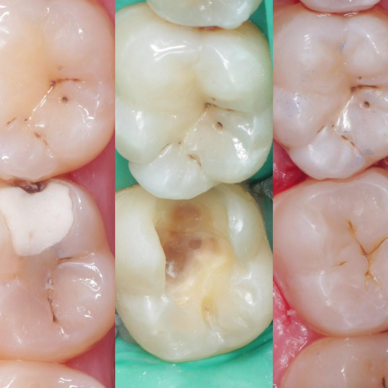 Стоматология в Твери - Линия Улыбки Лечение кариеса. Стоматология в Твери - Линия Улыбки