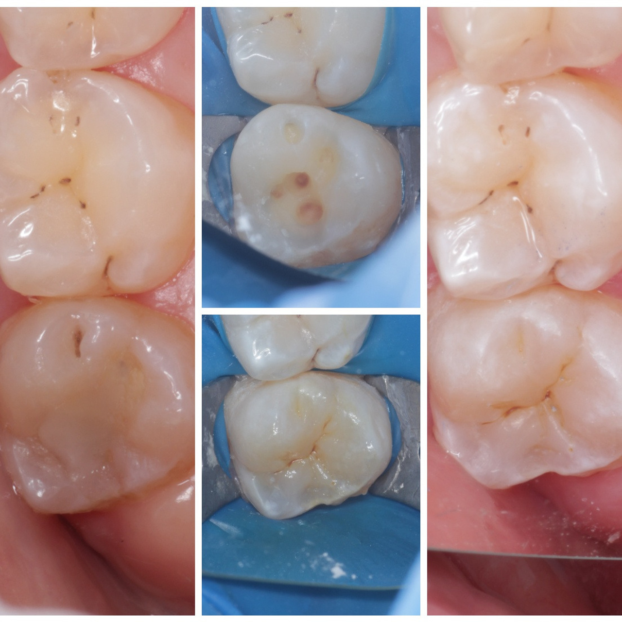Стоматология в Твери - Линия Улыбки Лечение кариеса. Стоматология в Твери - Линия Улыбки