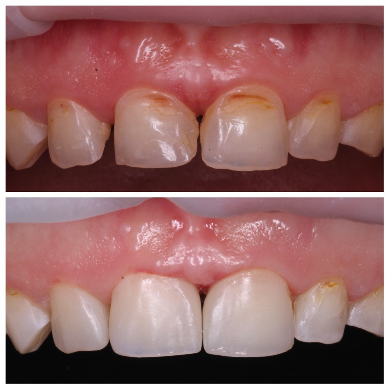 Стоматология в Твери - Линия Улыбки Лечение кариеса. Стоматология в Твери - Линия Улыбки