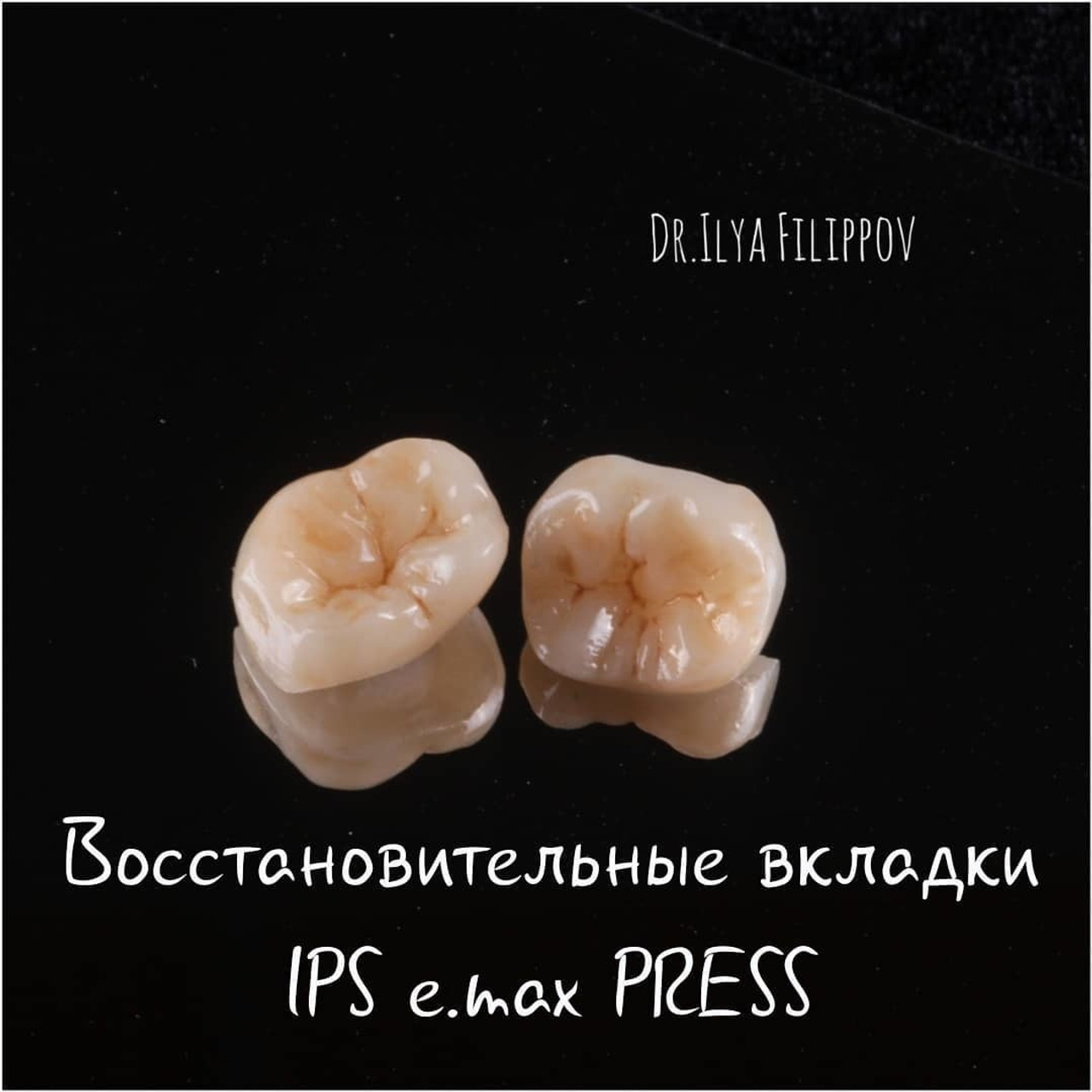 Цельнокерамические вкладки E.MAX PRESS.
