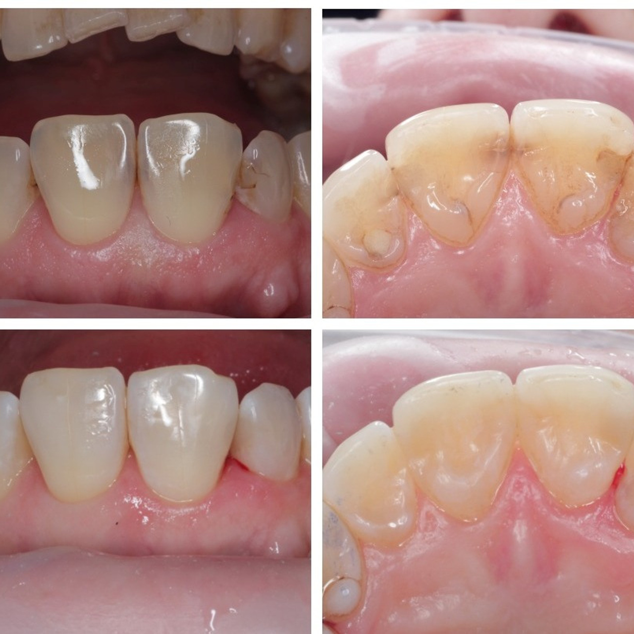 Стоматология в Твери - Линия Улыбки Лечение кариеса. Стоматология в Твери - Линия Улыбки