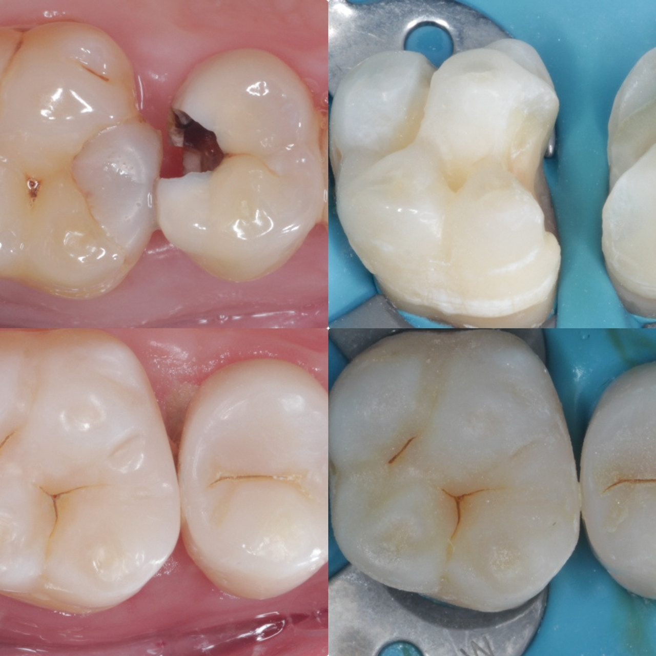 Стоматология в Твери - Линия Улыбки Лечение кариеса. Стоматология в Твери - Линия Улыбки