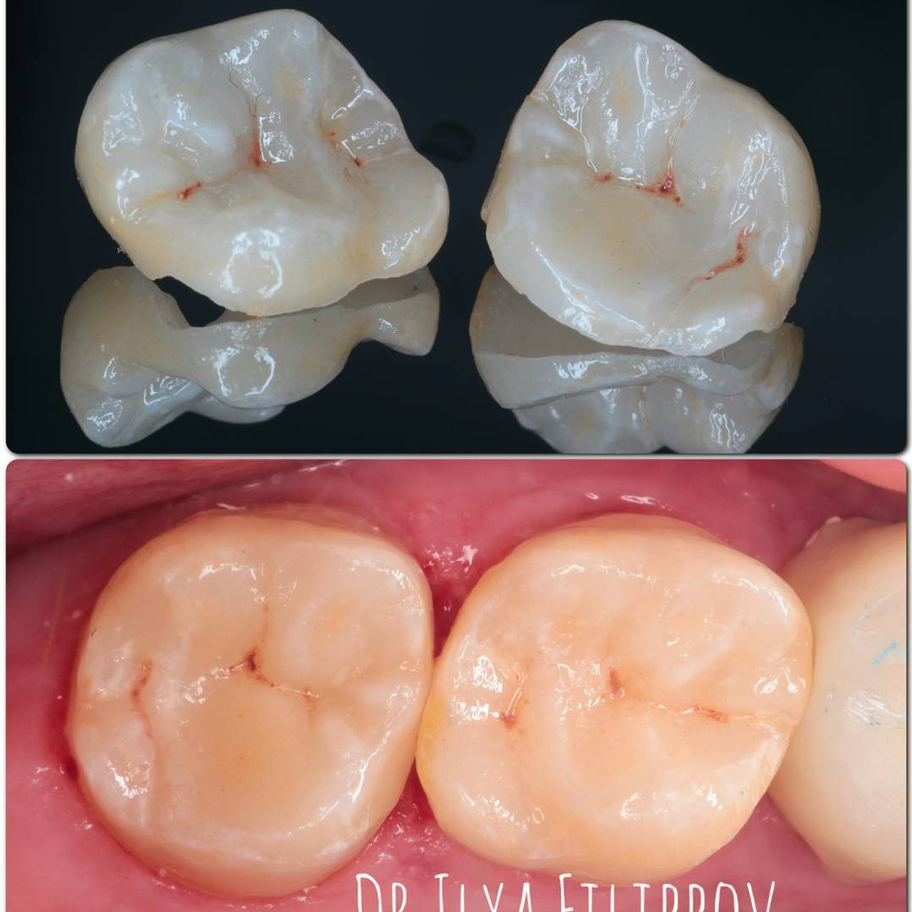 цельнокерамическая вкладка,керамическая вкладка,протезирование зубов,тверь,линия улыбки тверь,стоматология,филиппов илья юрьевич,стоматолог