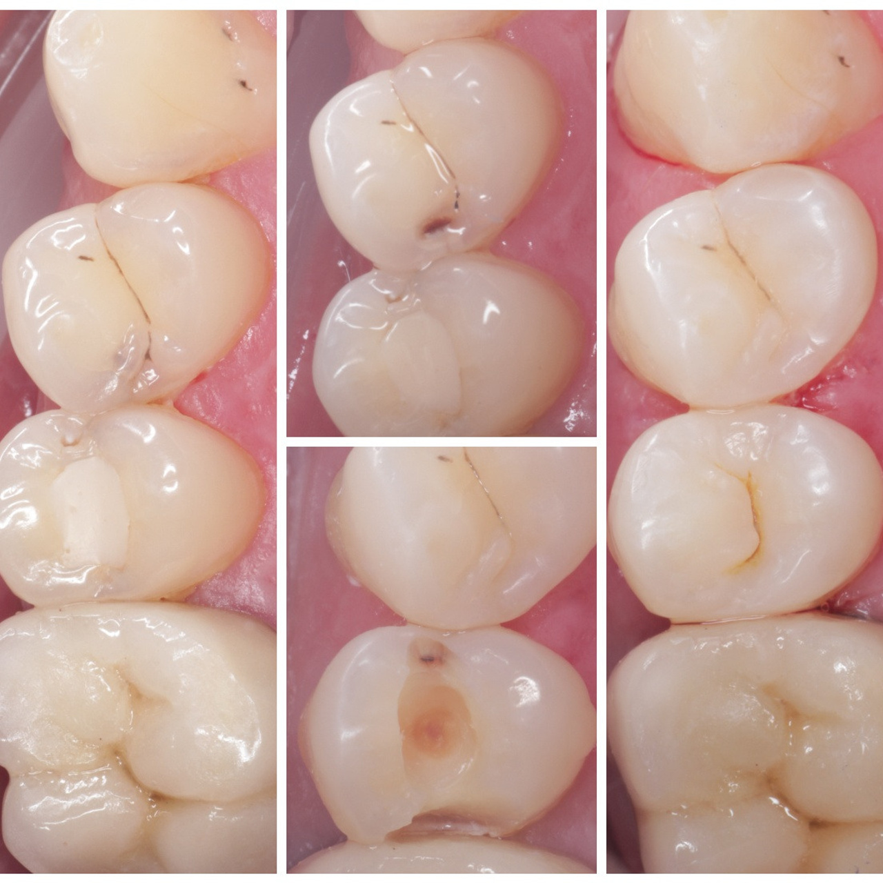 Стоматология в Твери - Линия Улыбки Лечение кариеса. Стоматология в Твери - Линия Улыбки