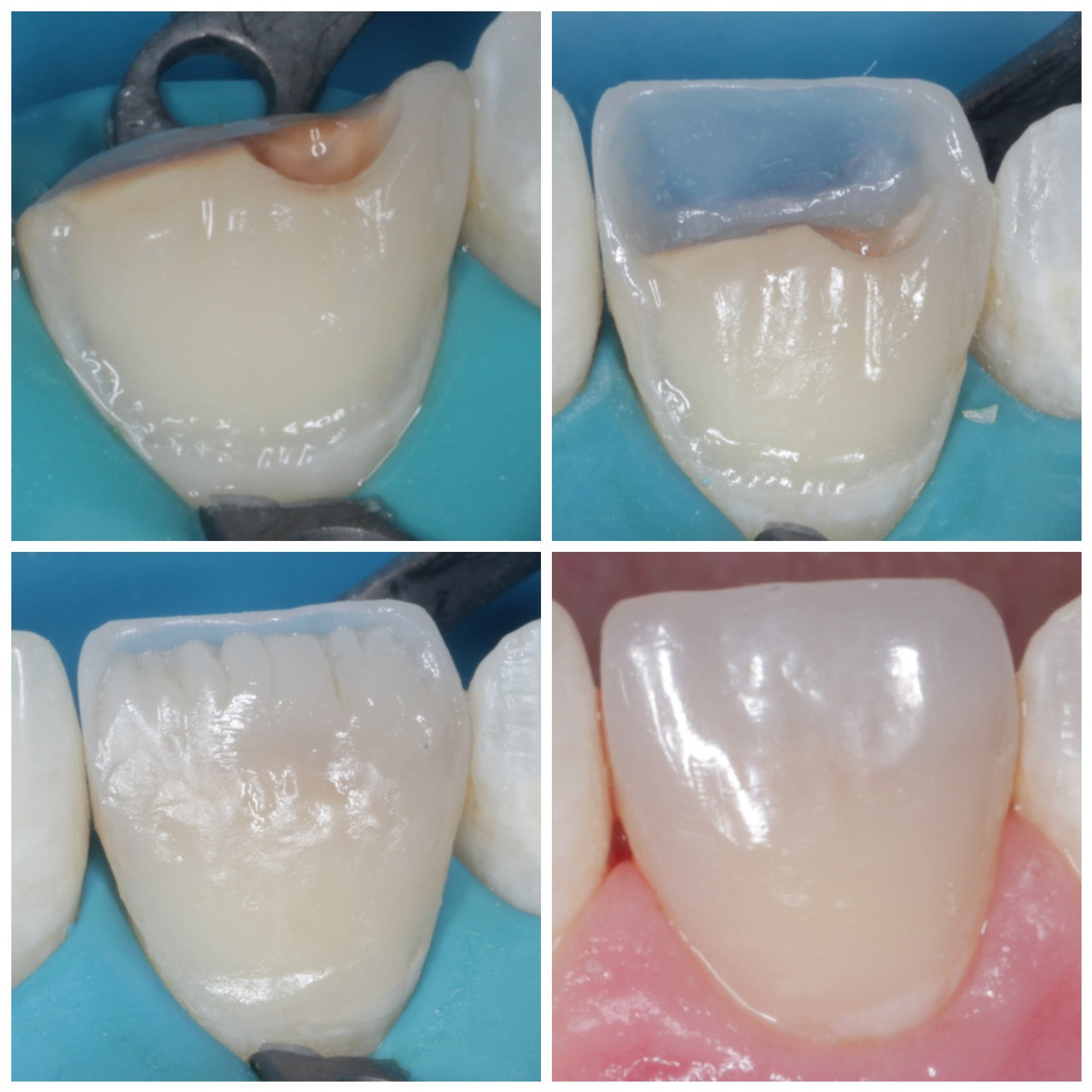 Стоматология в Твери - Линия Улыбки Лечение кариеса. Стоматология в Твери - Линия Улыбки