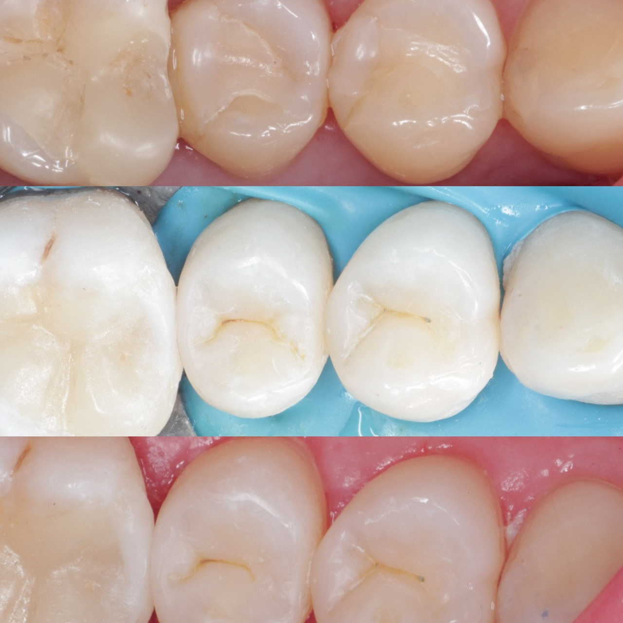 Стоматология в Твери - Линия Улыбки Лечение кариеса. Стоматология в Твери - Линия Улыбки