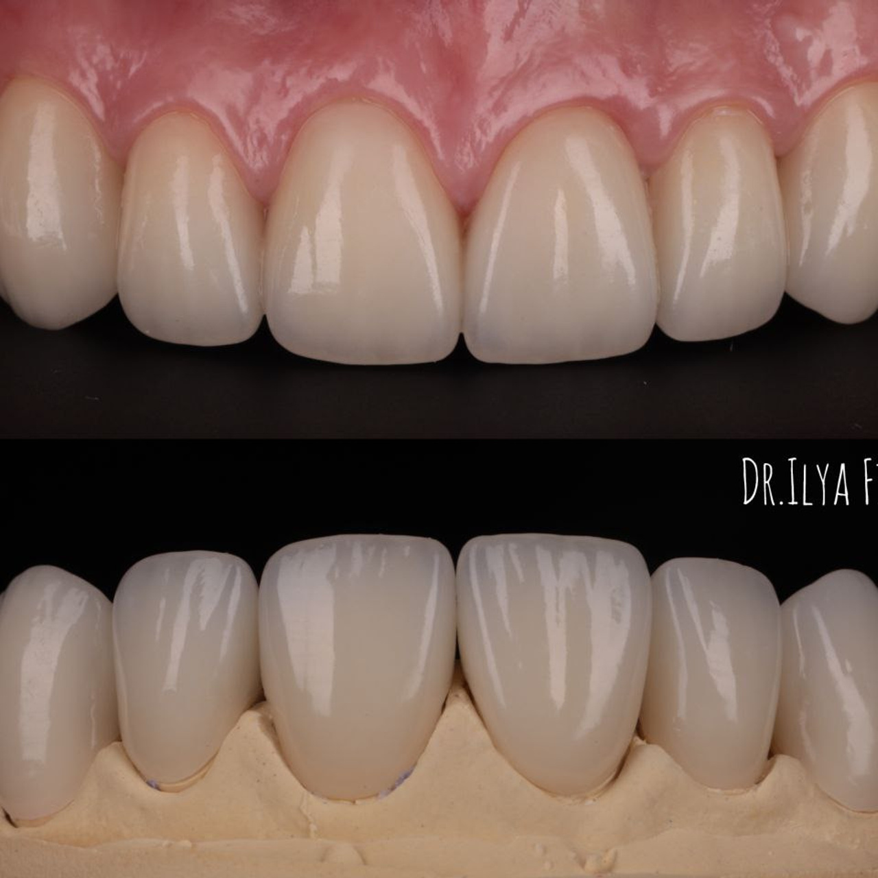 Стоматология в Твери - Линия Улыбки Коронки. Стоматология в Твери - Линия Улыбки