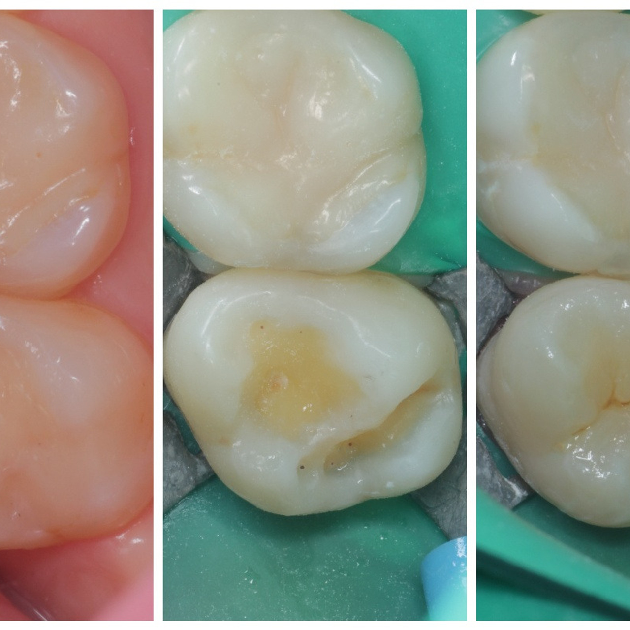 Стоматология в Твери - Линия Улыбки Лечение кариеса. Стоматология в Твери - Линия Улыбки