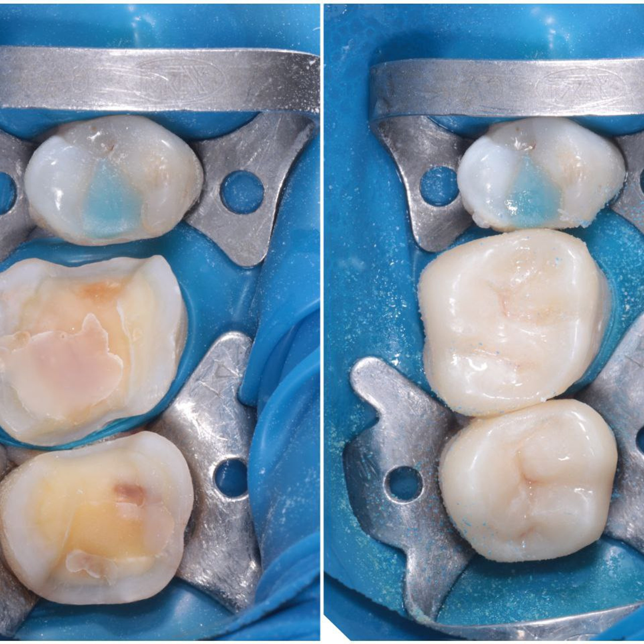 Стоматология в Твери - Линия Улыбки Коронки. Стоматология в Твери - Линия Улыбки