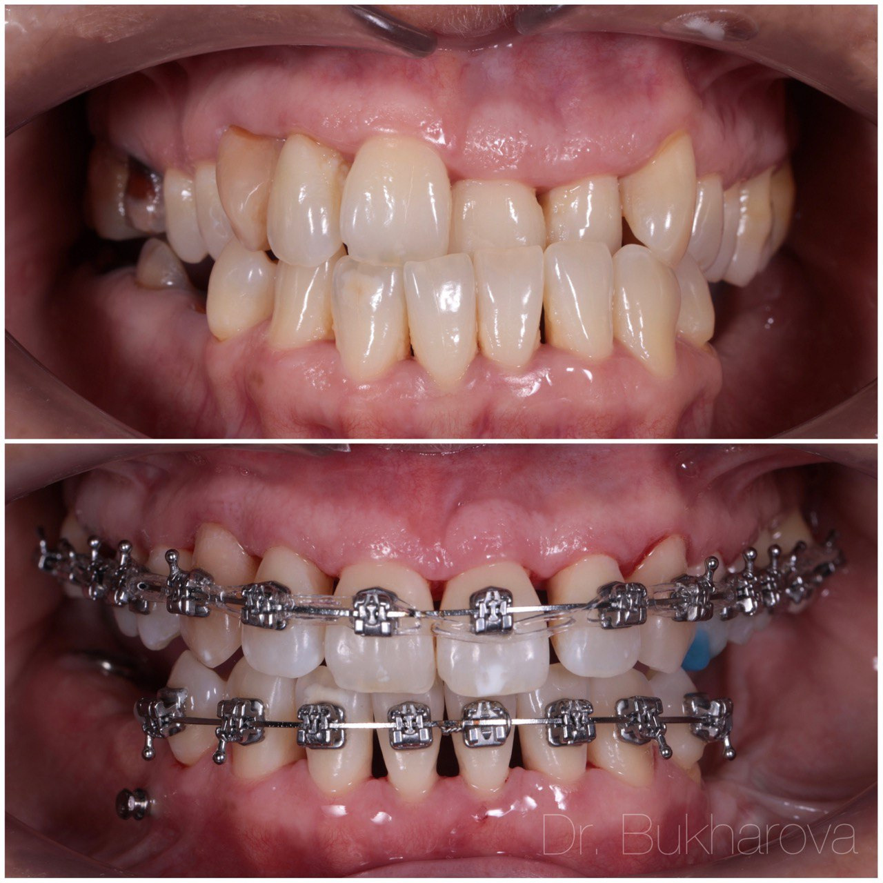 Ортодонтия. Стоматология в Твери - Линия Улыбки