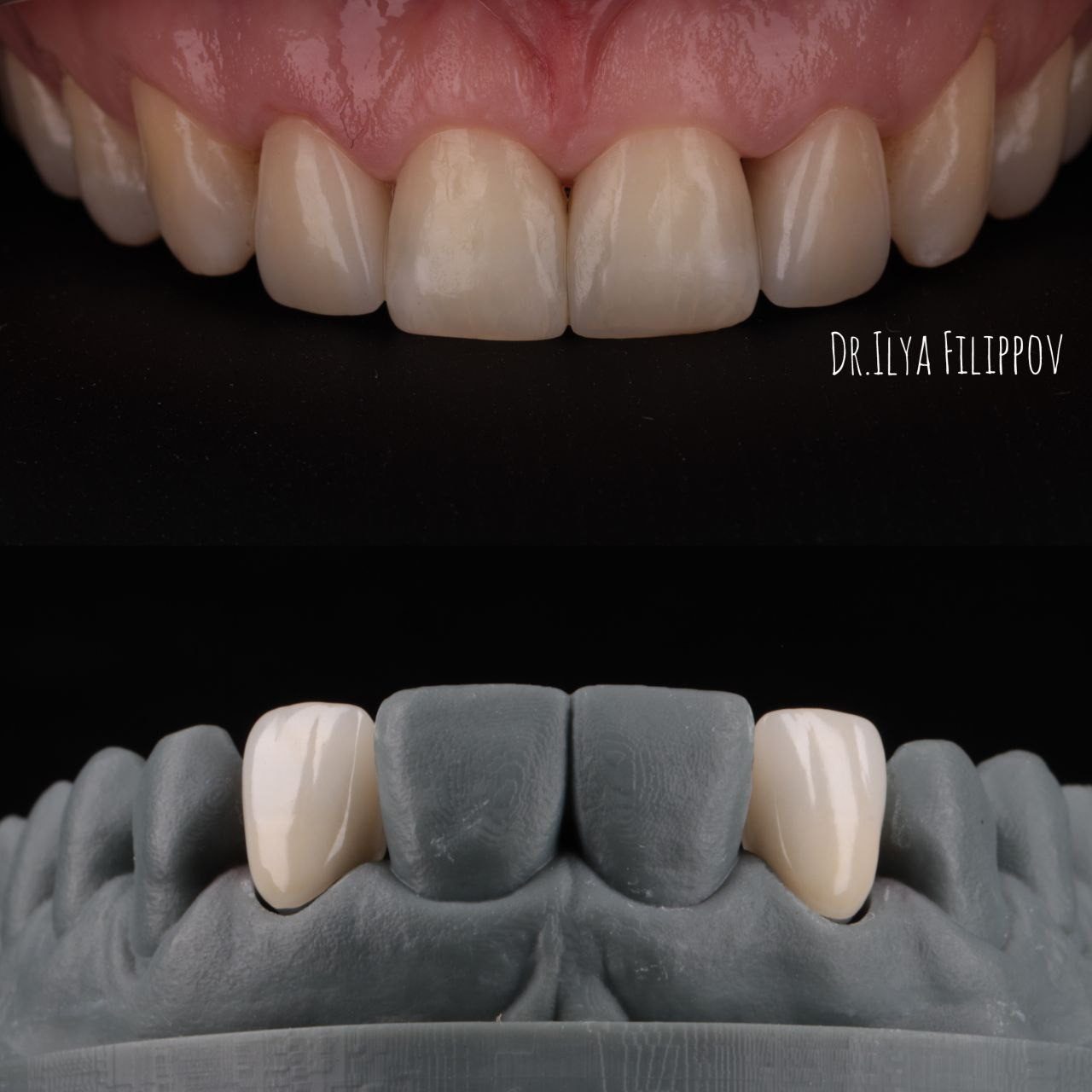 Стоматология в Твери - Линия Улыбки Коронки. Стоматология в Твери - Линия Улыбки