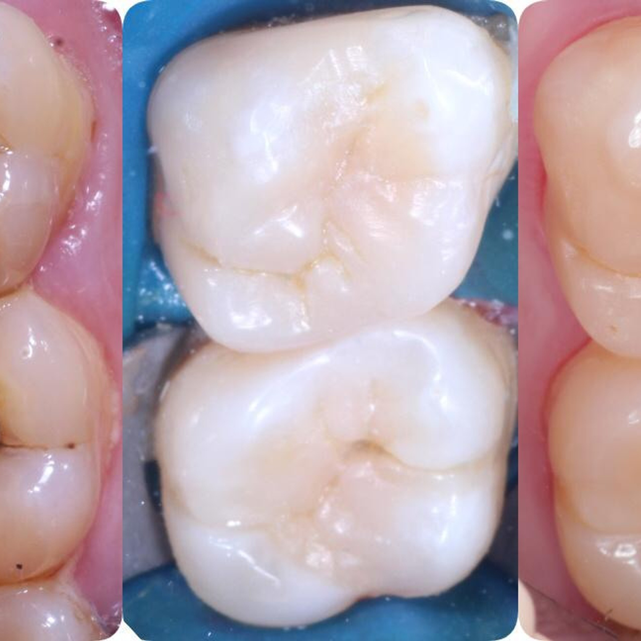 Стоматология в Твери - Линия Улыбки Лечение кариеса. Стоматология в Твери - Линия Улыбки