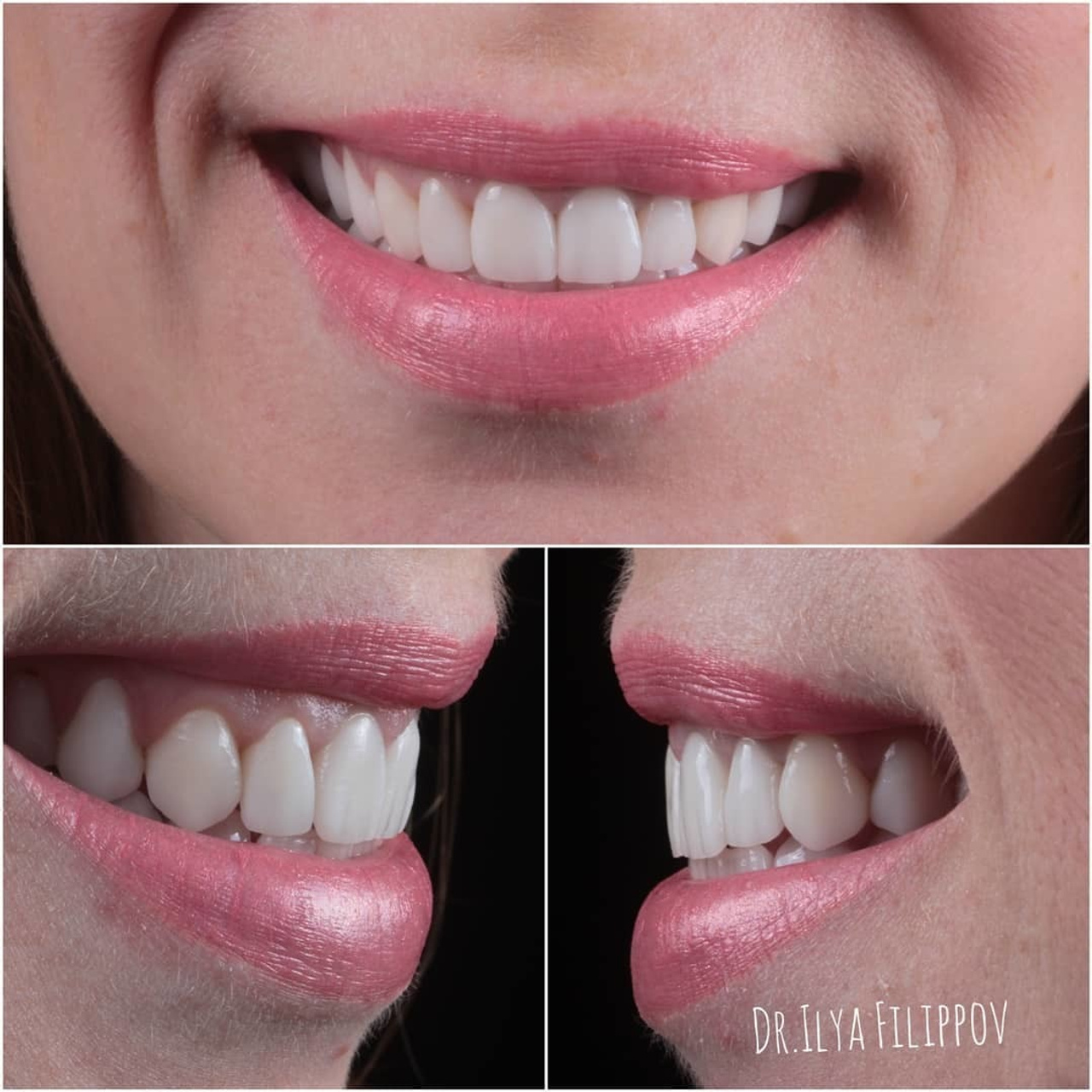 винир,коронка,стоматология,тверь,протезирование зубов,лечение зубов под микроскопом,филиппов илья юрьевич,линия улыбки