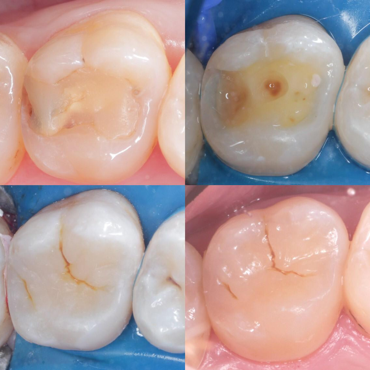 Стоматология в Твери - Линия Улыбки Лечение кариеса. Стоматология в Твери - Линия Улыбки