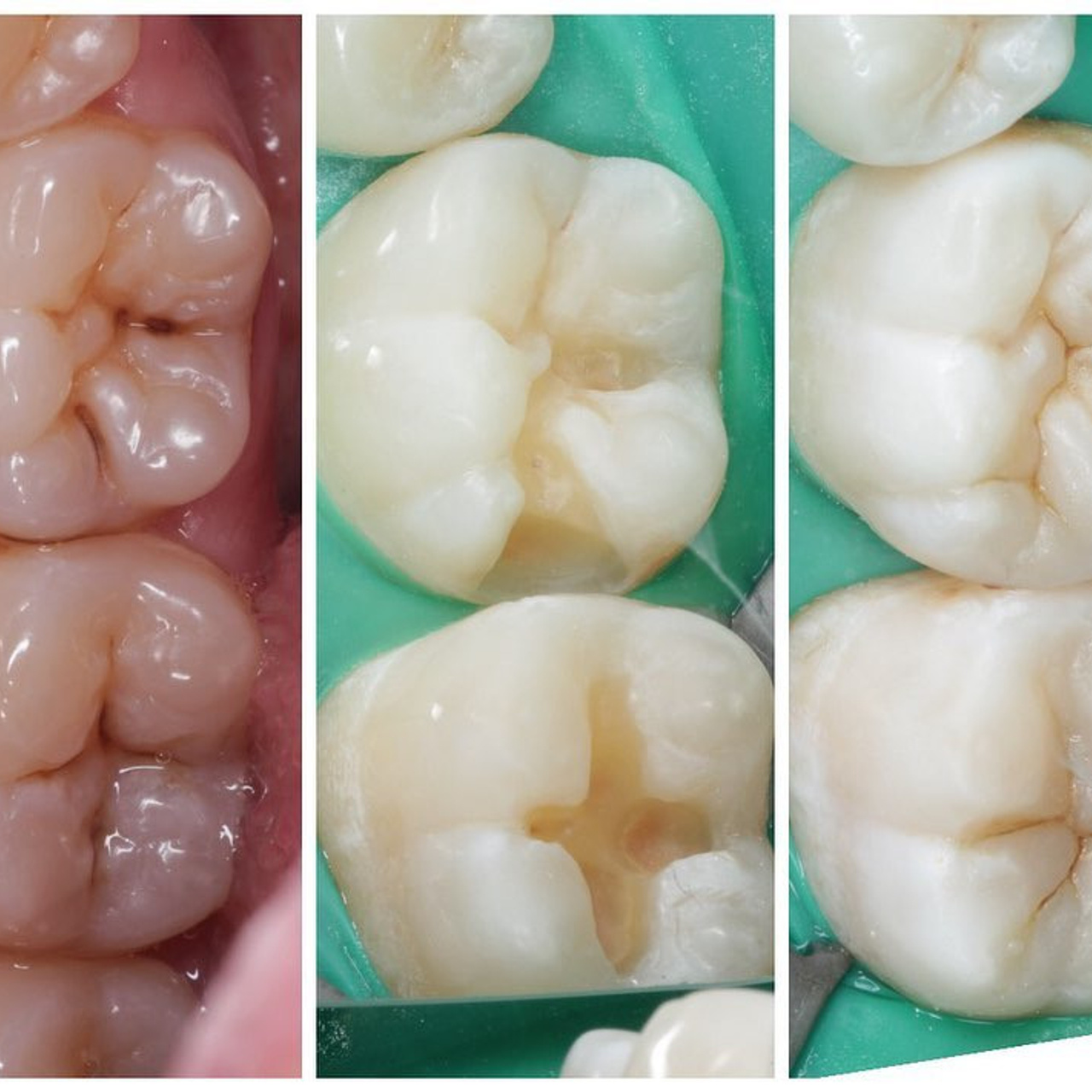 Стоматология в Твери - Линия Улыбки Лечение кариеса. Стоматология в Твери - Линия Улыбки