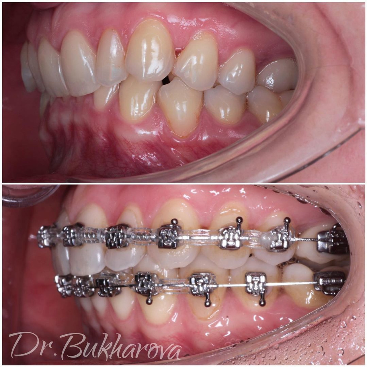 Ортодонтия. Стоматология в Твери - Линия Улыбки