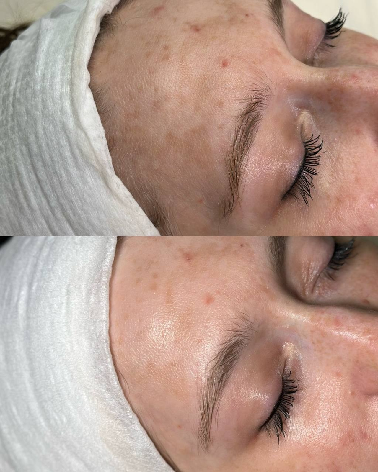 Чистка лица СПб