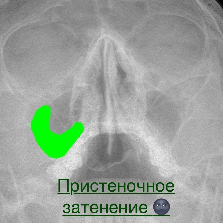 Разбираемся с пазухами на рентгене. Первые шаги. РЕНТГЕН КТ МРТ в Санкт-Петербурге Александра Лоншакова