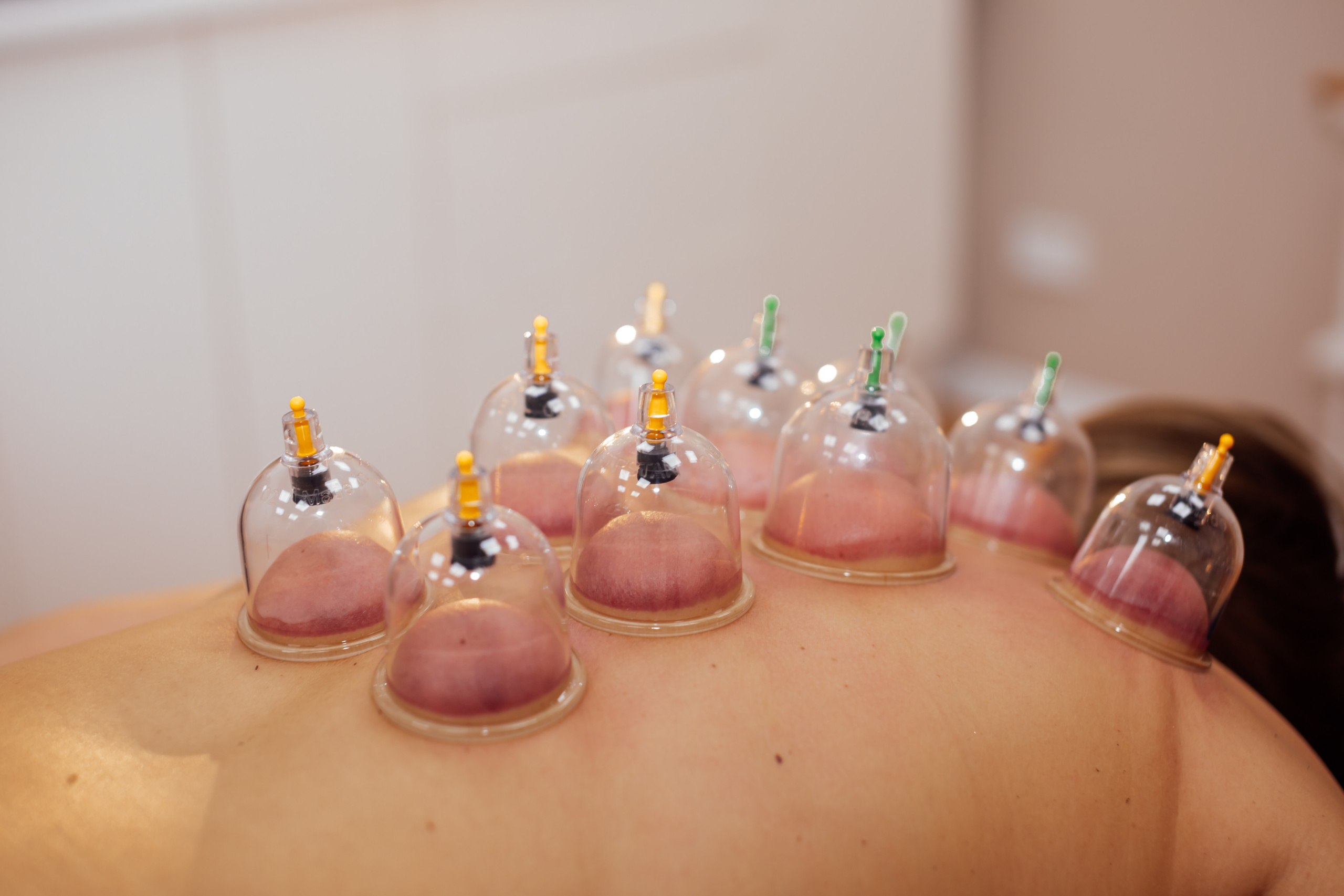 ВАККУМТЕРАПИЯ. Https://esmassage.ru