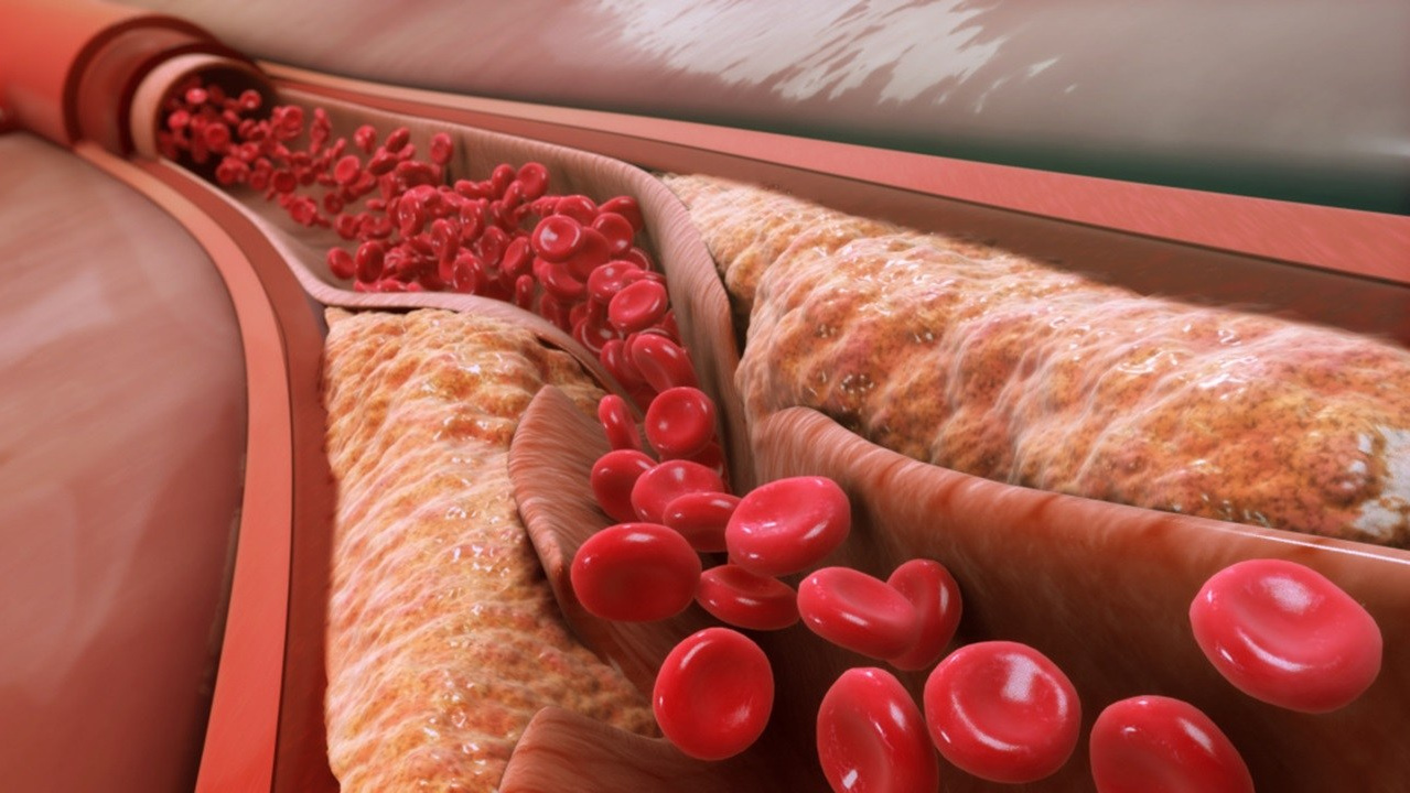 Какие препараты компании Сово-Сова помогут при атеросклерозе