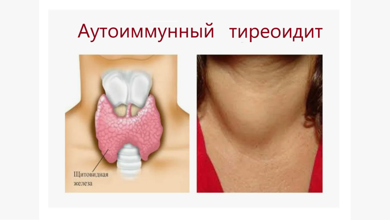 Аутоиммунный тиреоидит щитовидной железы - какие препараты компании Сово-Сова помогут
