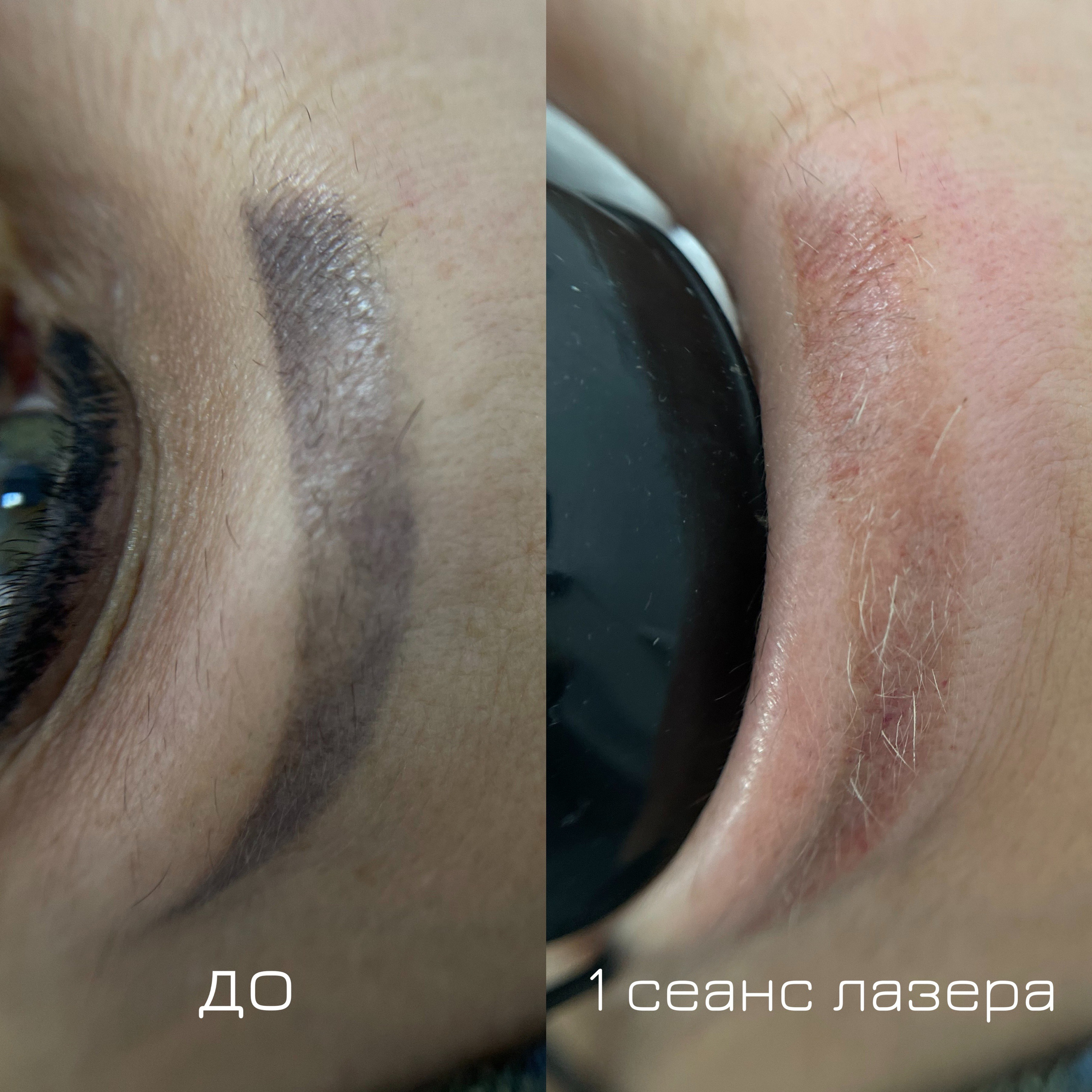 Лазерное удаление бровей Ростов
