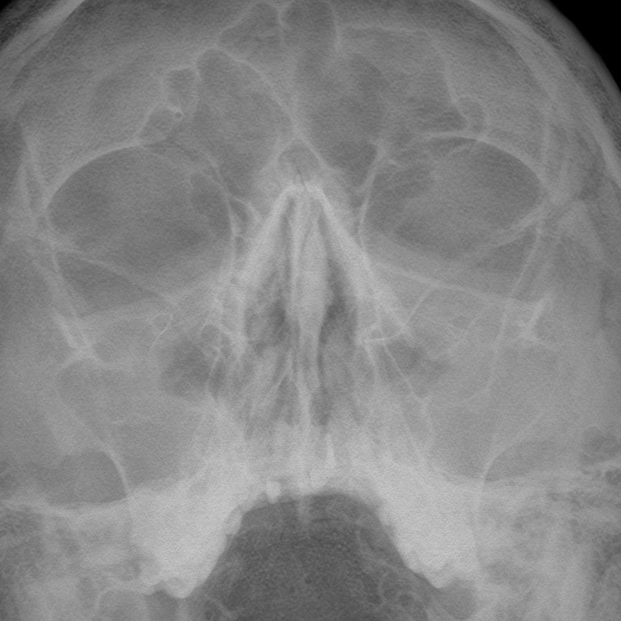 Разбираемся с пазухами на рентгене. Первые шаги. РЕНТГЕН КТ МРТ в Санкт-Петербурге Александра Лоншакова