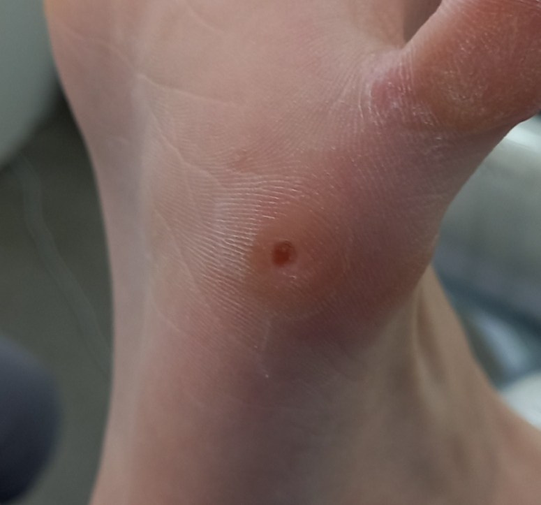 Обработка стержневой мозоли. Подолог г. Хабаровск — центр здоровой стопы «FOOTTIME»