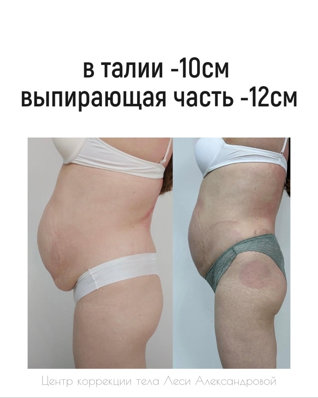 Результаты. Центр Коррекции Тела в городе Чехов