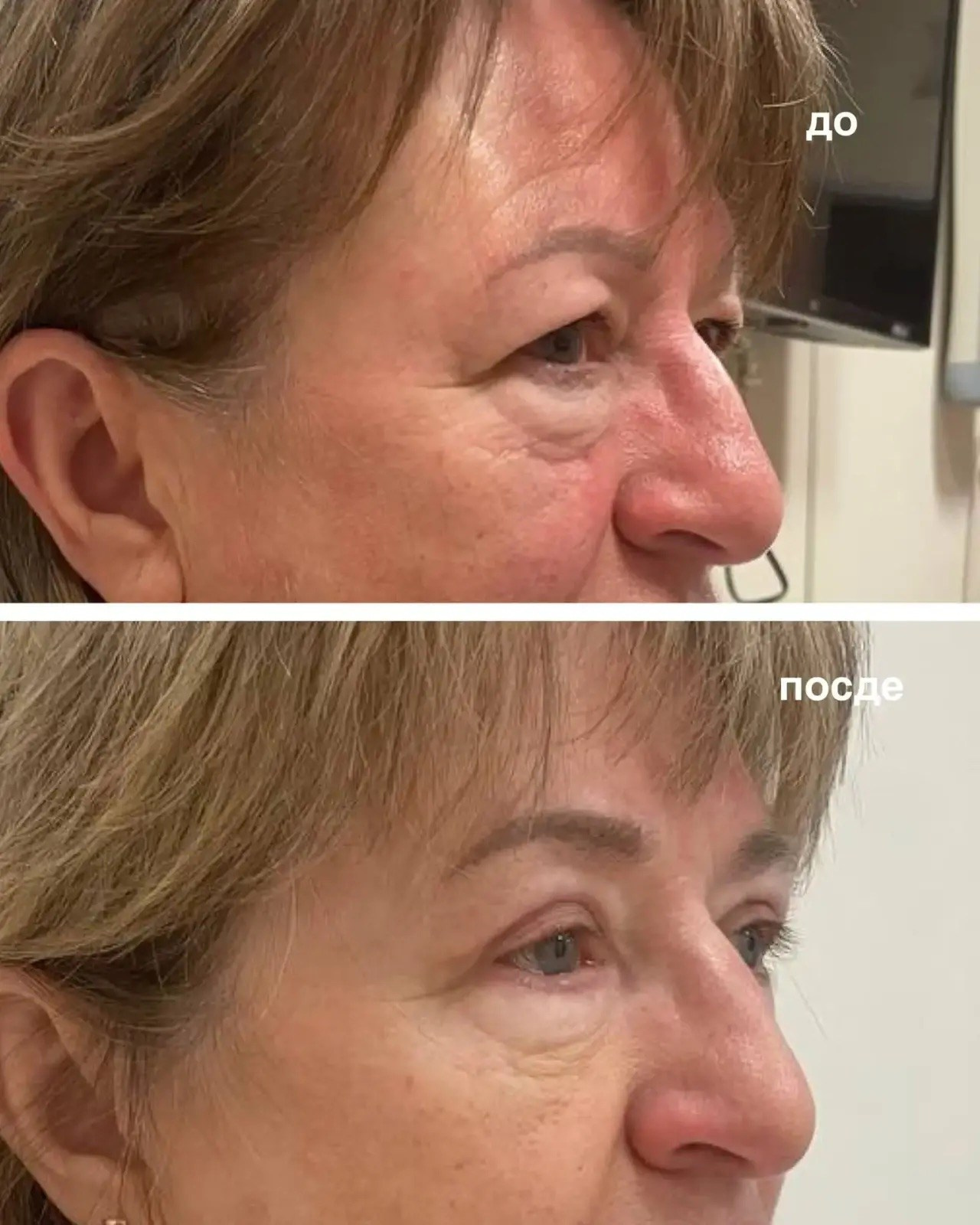 Результат круговой блефаропластики через месяц после операции 💥. Горбачевская Ксения Андреевна — пластический хирург