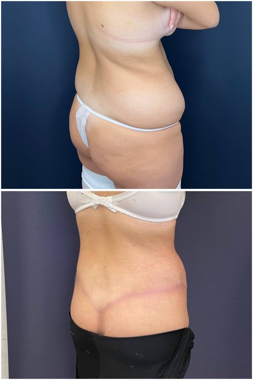 Всех приветствую! Результат нижнего бодилифтинга через 2 месяца после операции. Горбачевская Ксения Андреевна — пластический хирург