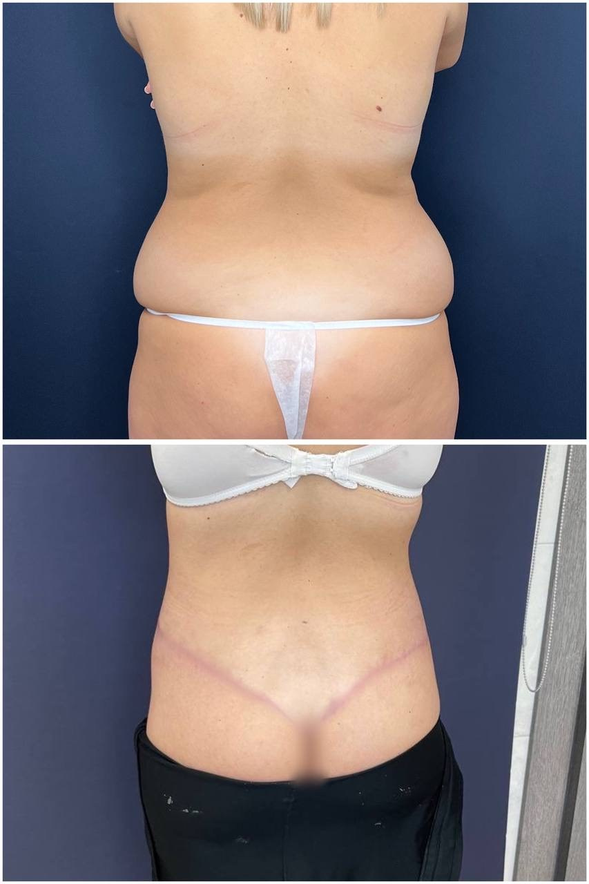 Всех приветствую! Результат нижнего бодилифтинга через 2 месяца после операции. Горбачевская Ксения Андреевна — пластический хирург