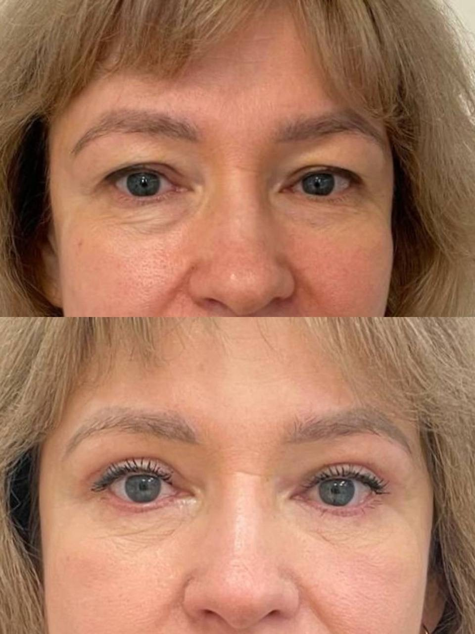Блефаропластика и лифтинг верхних век. Горбачевская Ксения Андреевна — пластический хирург