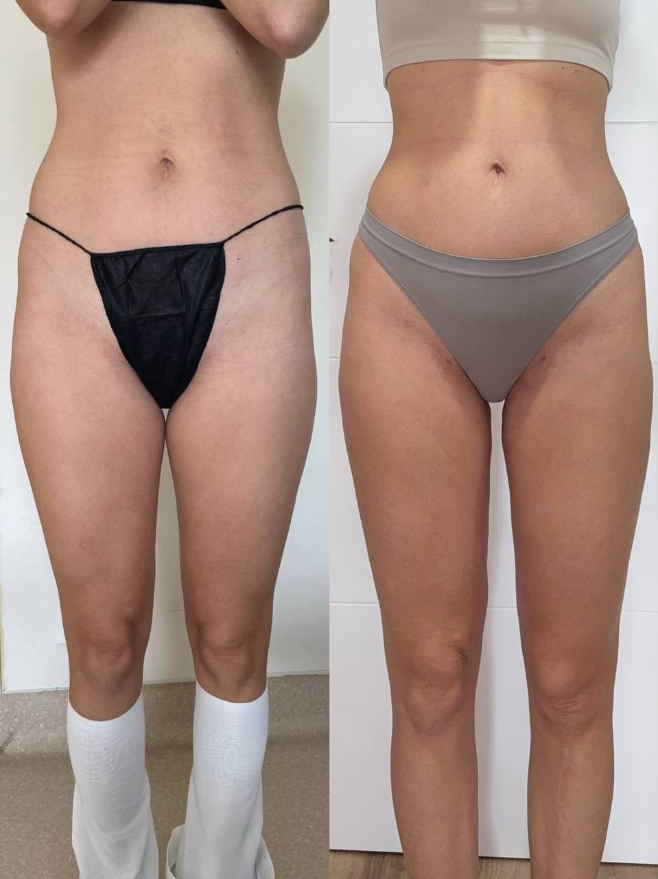 Результат липоскульптурирования и липомоделирования. Горбачевская Ксения Андреевна — пластический хирург
