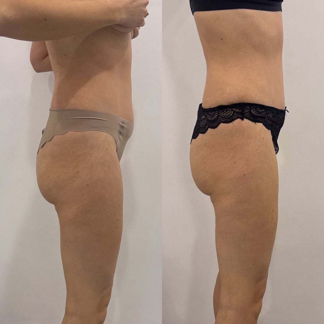 Аппаратный массаж, эндосфера, ручной массаж. Студия перманентного макияжа, косметологии и массажа SYMMETRY в Москве, м. Киевская