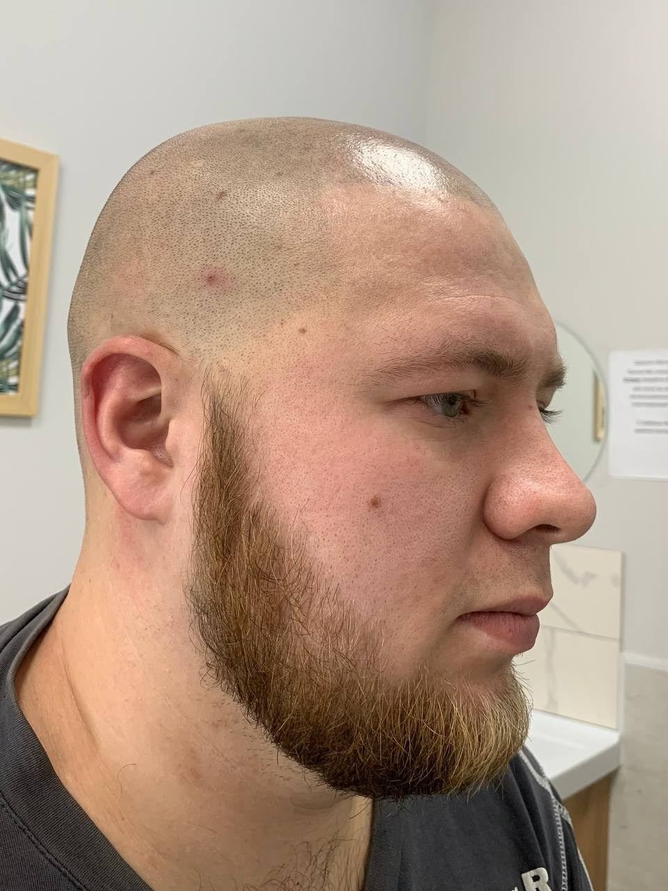 Нажмите на фото что бы открыть. SMP Трихопигментация Воронеж Волгоград Москва Казань Никита Нестеров