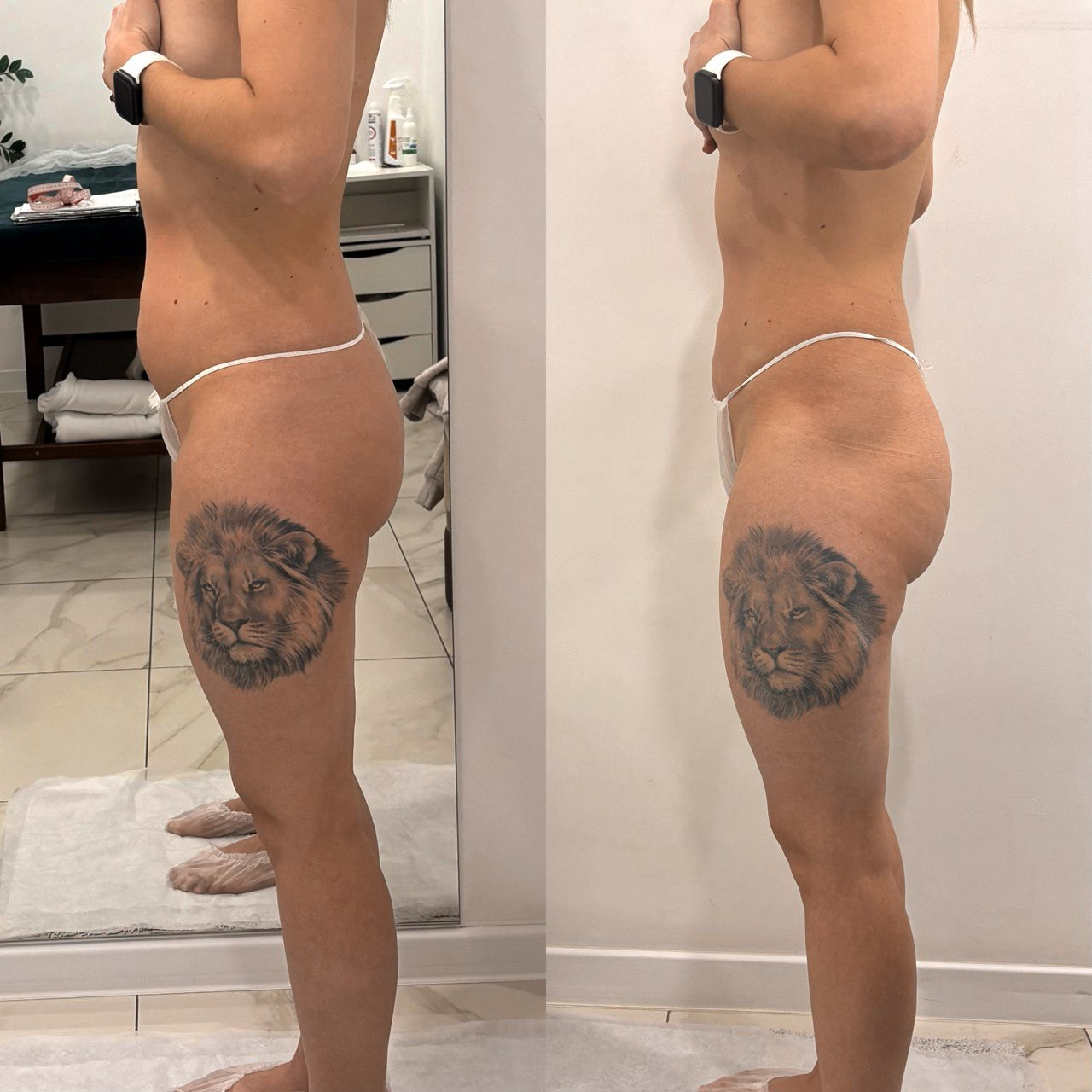 Аппаратный массаж BBEndospheres