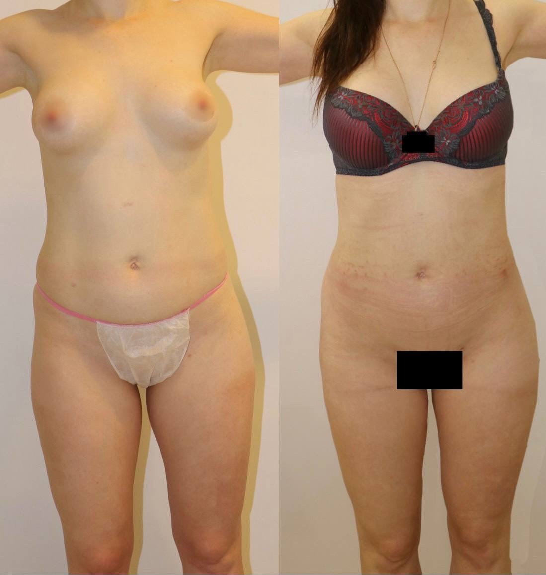 Результат липоскульптурирования и липомоделирования. Горбачевская Ксения Андреевна — пластический хирург