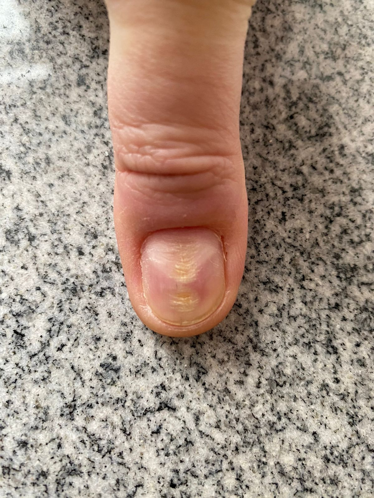 Самодеструкция. Подолог г. Хабаровск — центр здоровой стопы «FOOTTIME»